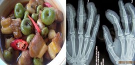 SUNG HẦM THỊT NẠC CHỮA ĐAU KHỚP, NẶNG ĐẾN LIỆT GIƯỜNG CŨNG KHỎI