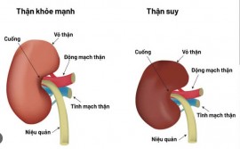 Thận suy không chỉ là chuyện của tuổi già